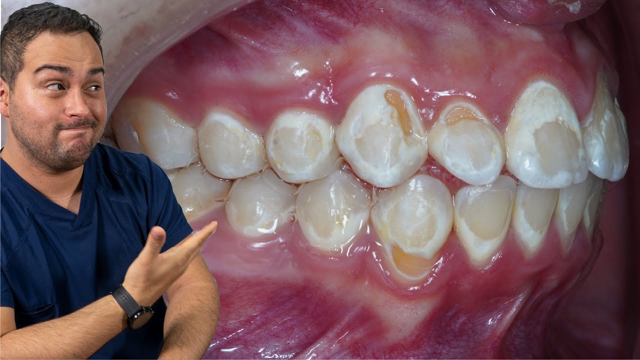 manchas blancas en los dientes con brackets