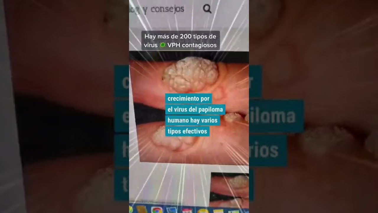 papiloma en el dedo de la mano
