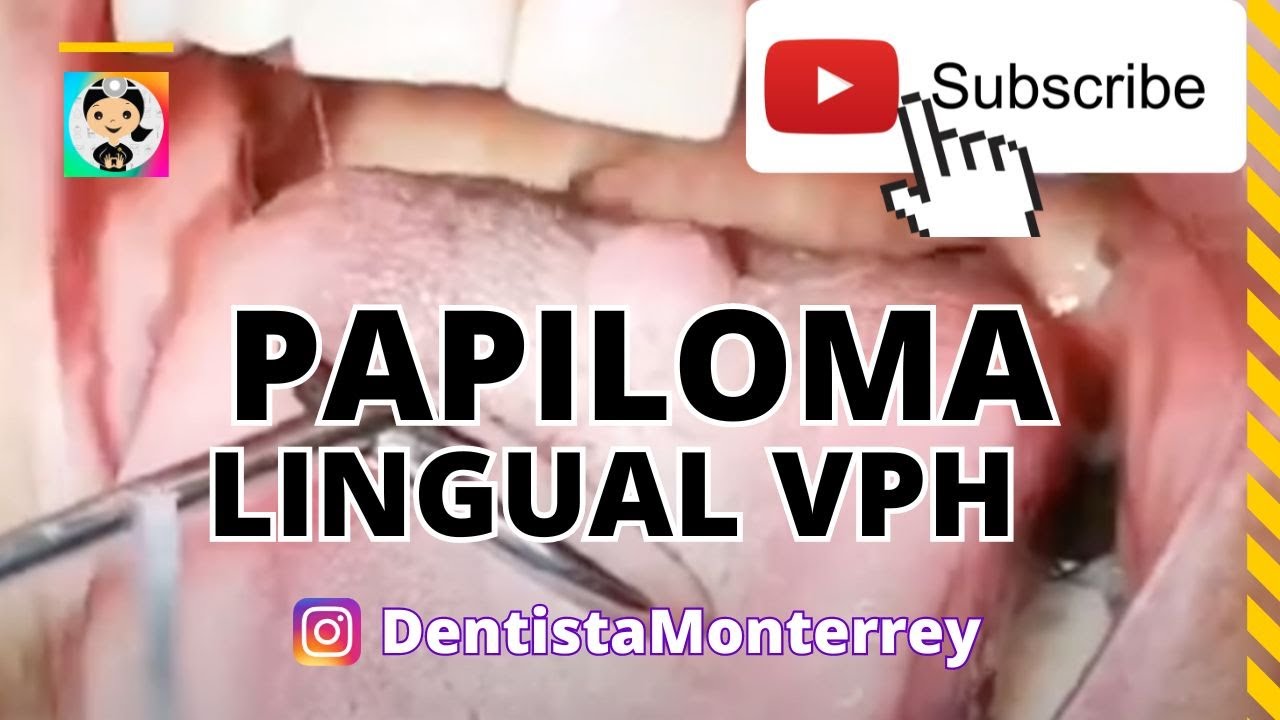 papiloma grano en la lengua vph