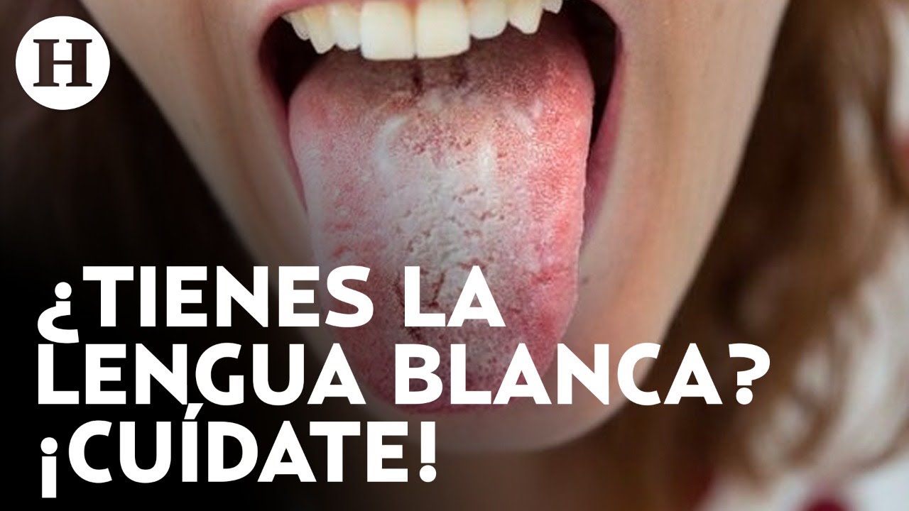 porque mi lengua tiene una capa blanca