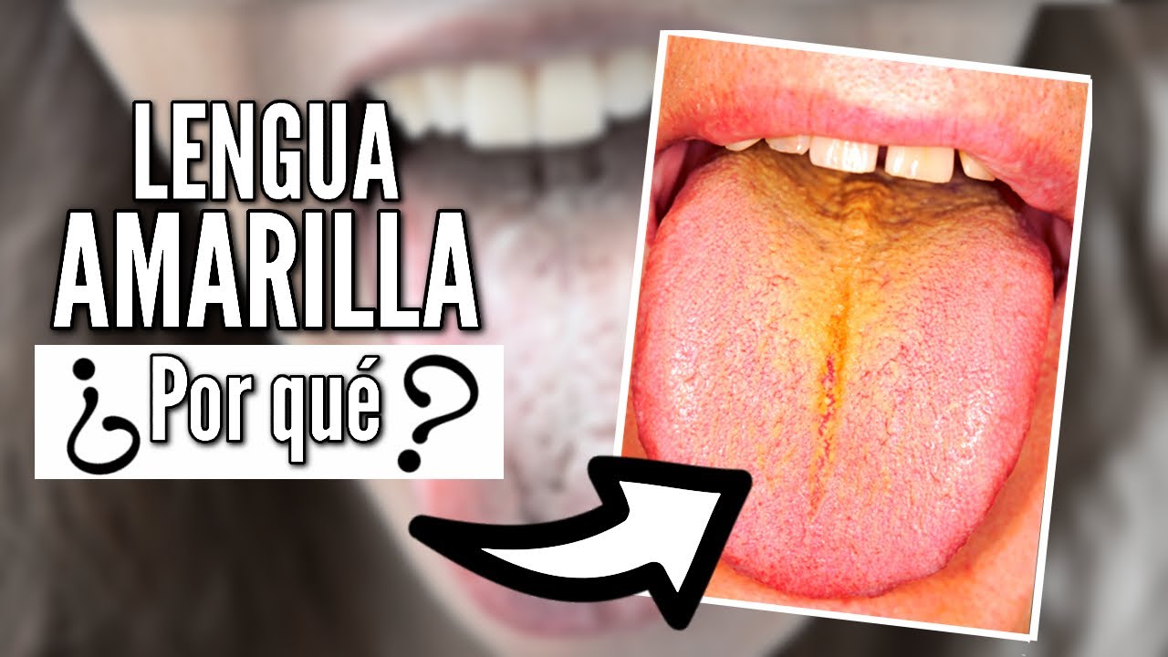 porque se pone la lengua amarilla