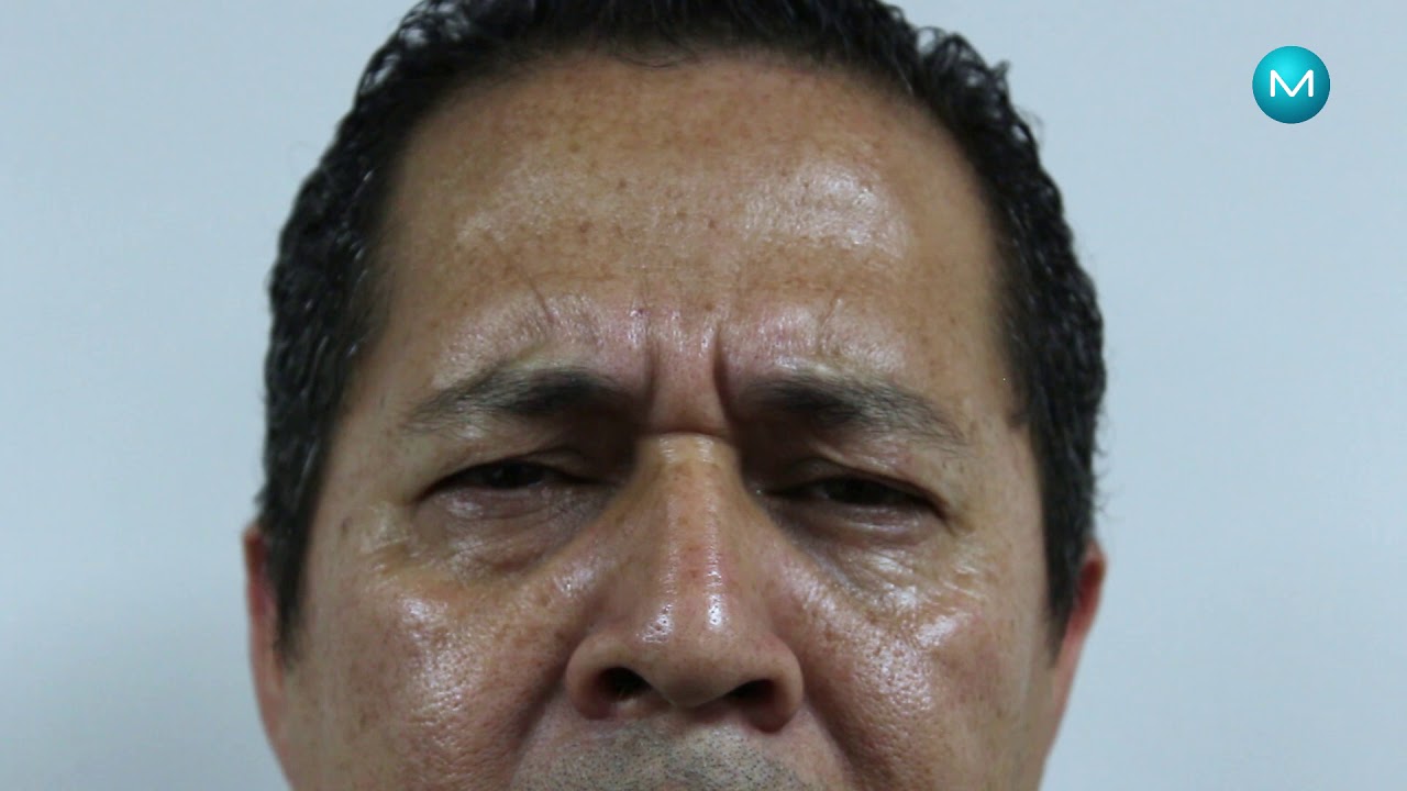 porque tarda tanto en hacer efecto el botox