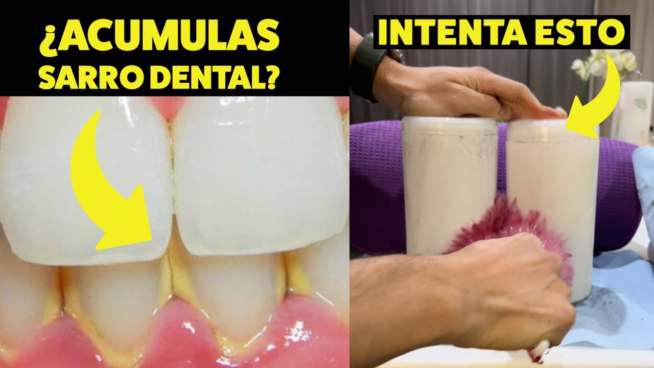 porque tengo sarro si me lavo los dientes
