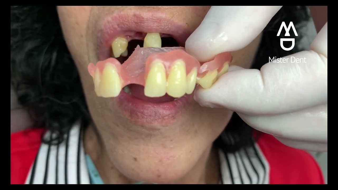 prótesis fija sobre dientes naturales precio