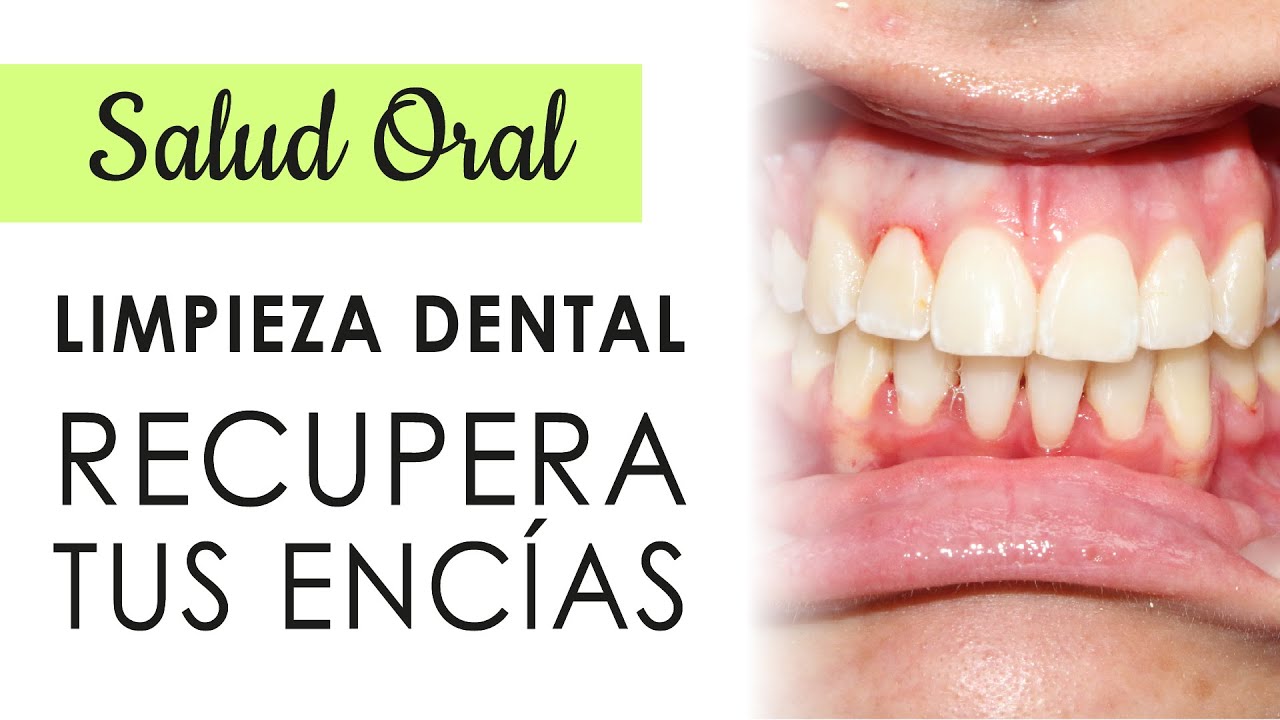 que hacer despues de una limpieza dental