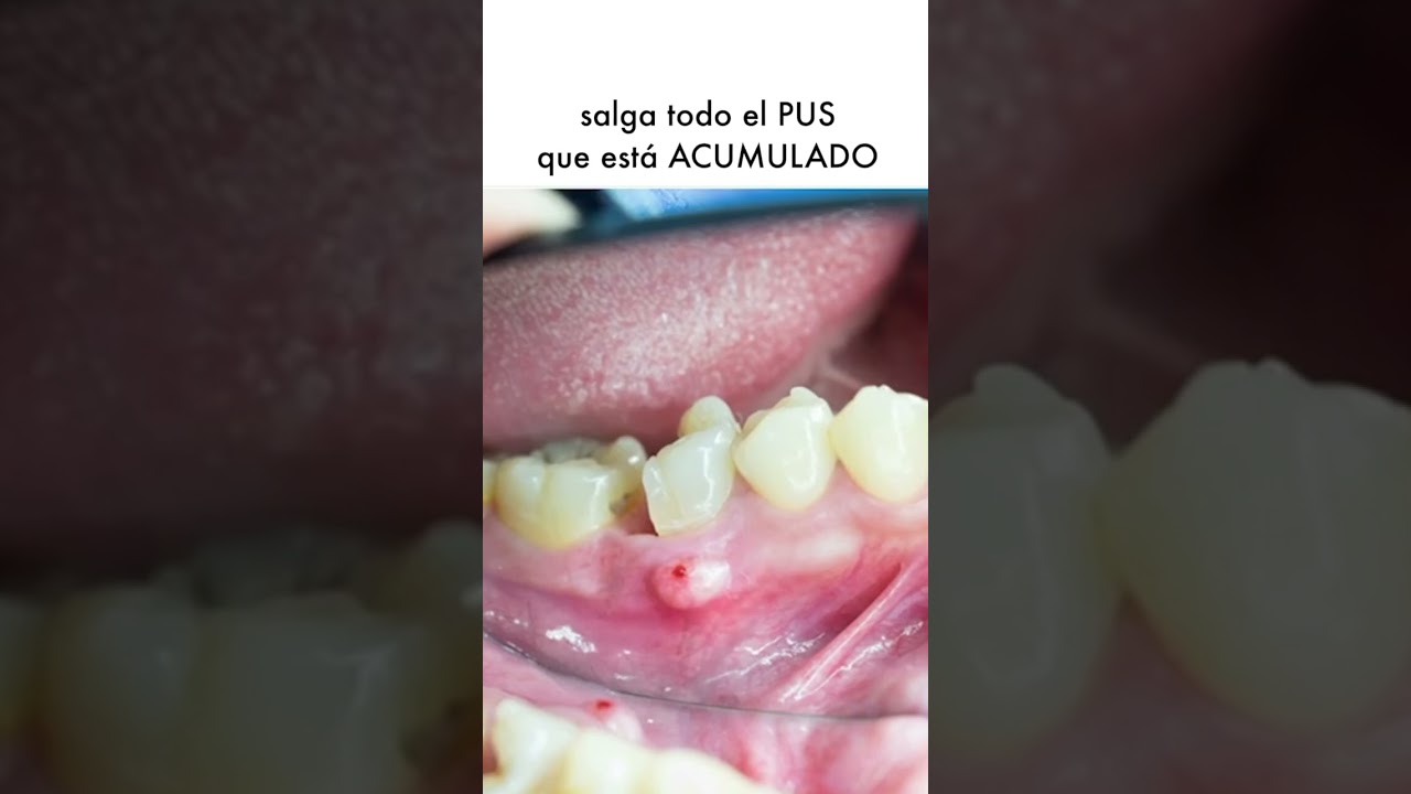 remedios caseros para reventar un absceso dental