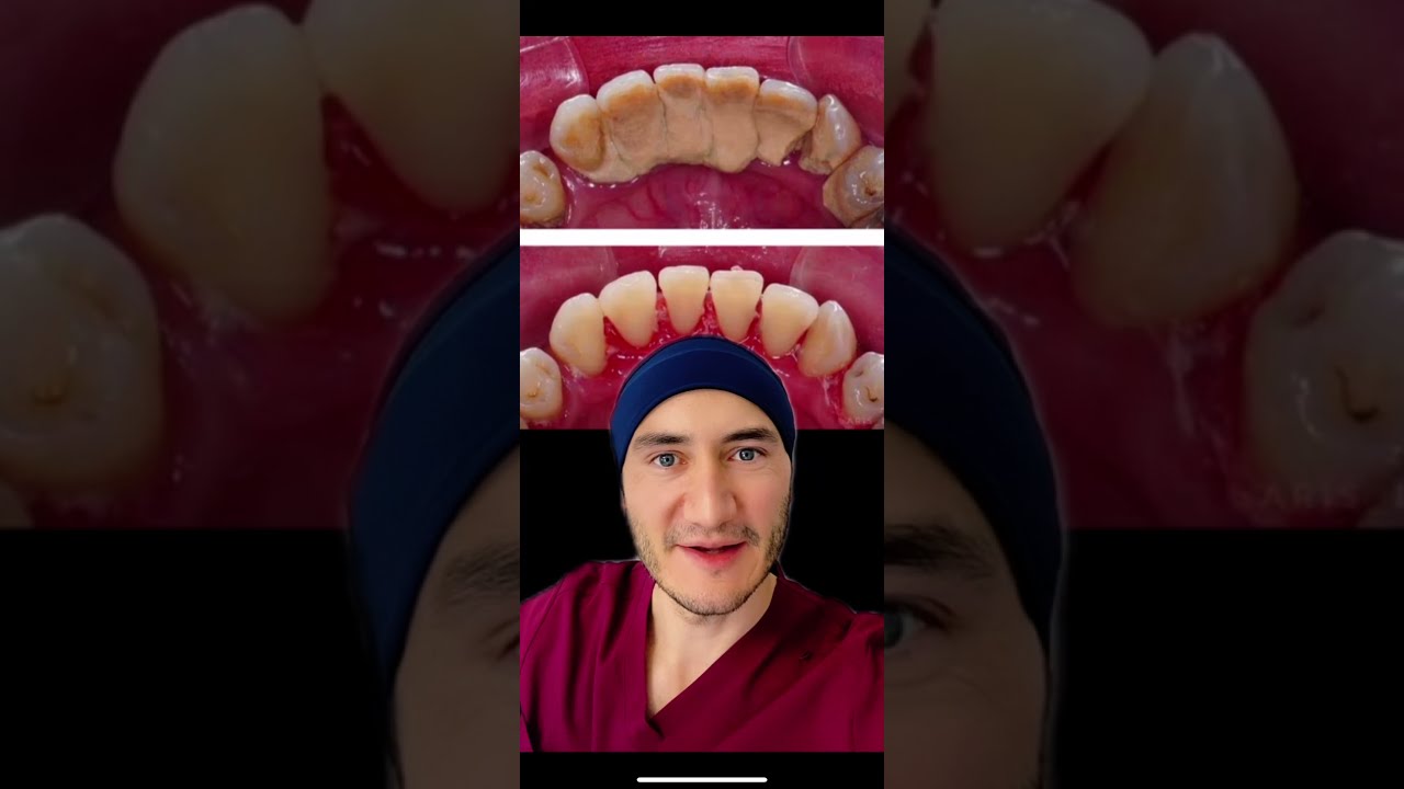 se puede fumar despues de una limpieza dental