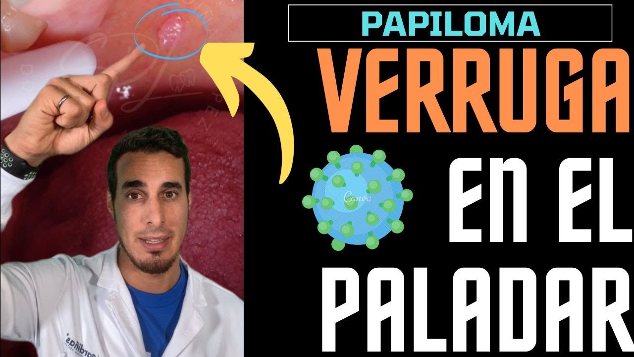 virus del papiloma en la boca