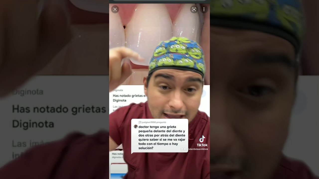 agrietado fisuras en los dientes frontales