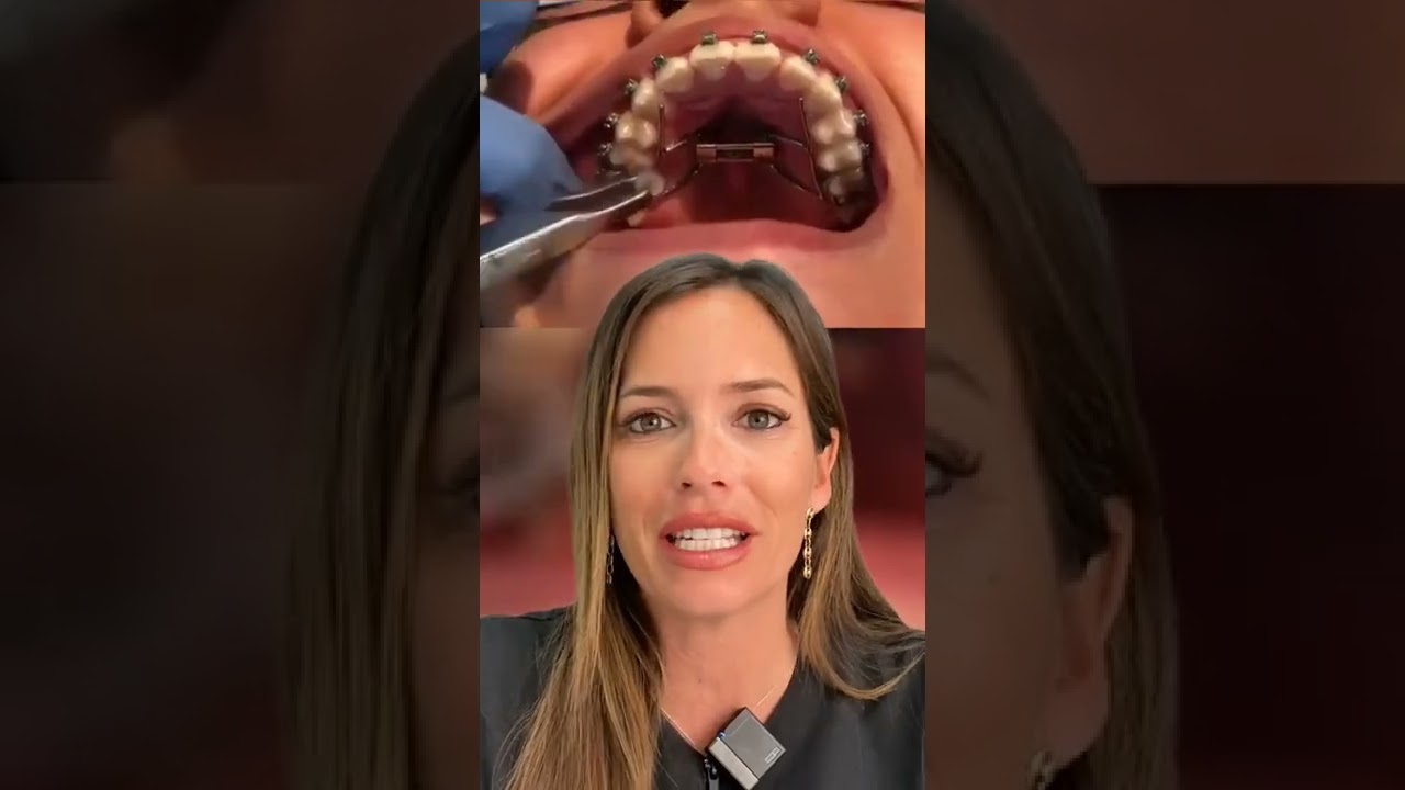 aparatos dentales que va uno en cada diente