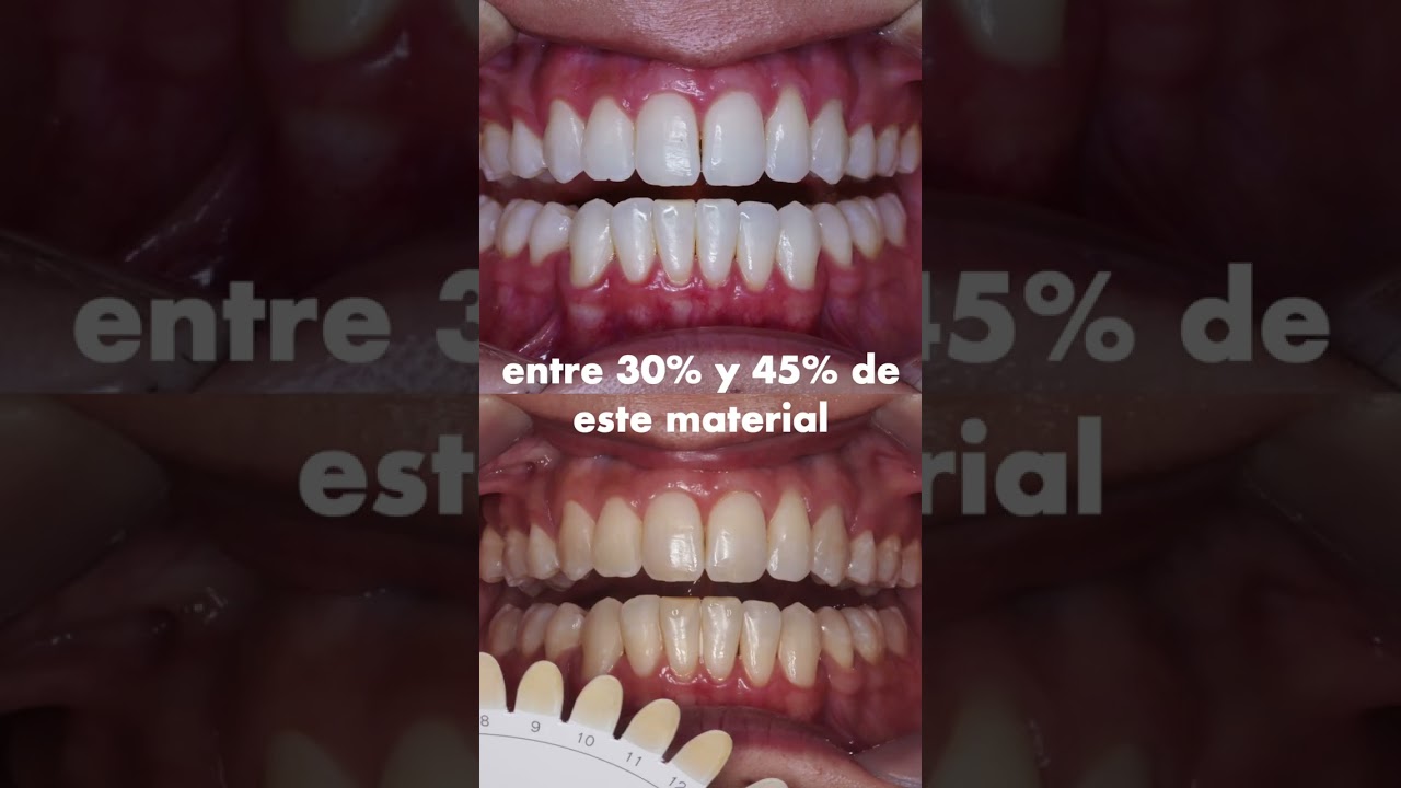 blanqueamiento dental casero sin dañar el esmalte