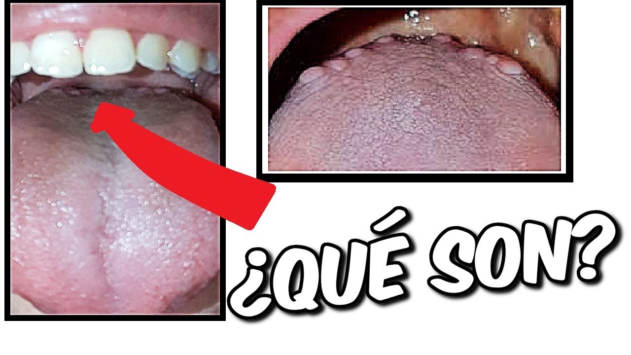 bolitas en la lengua cerca de la garganta