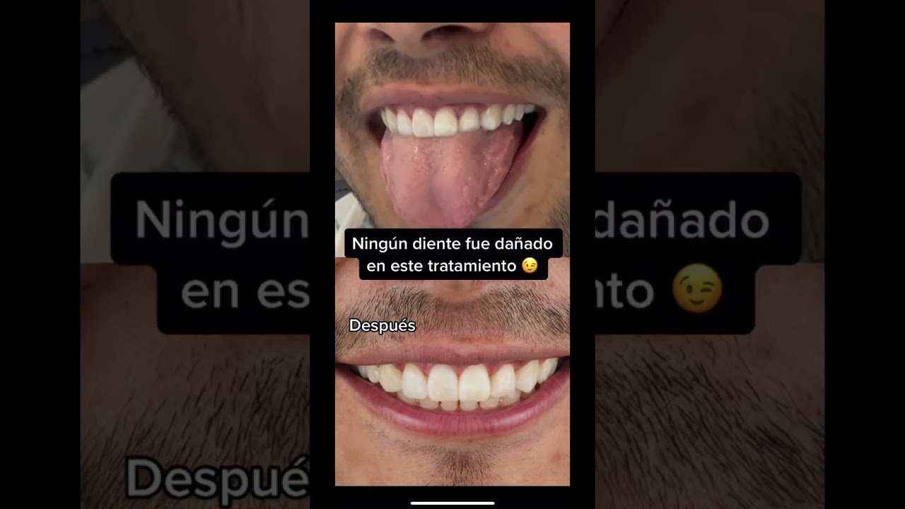 carillas de composite antes y después