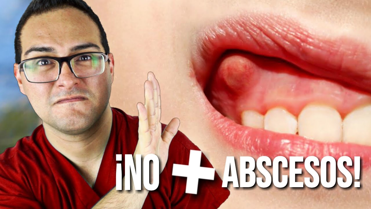 como desinflamar un absceso dental en casa