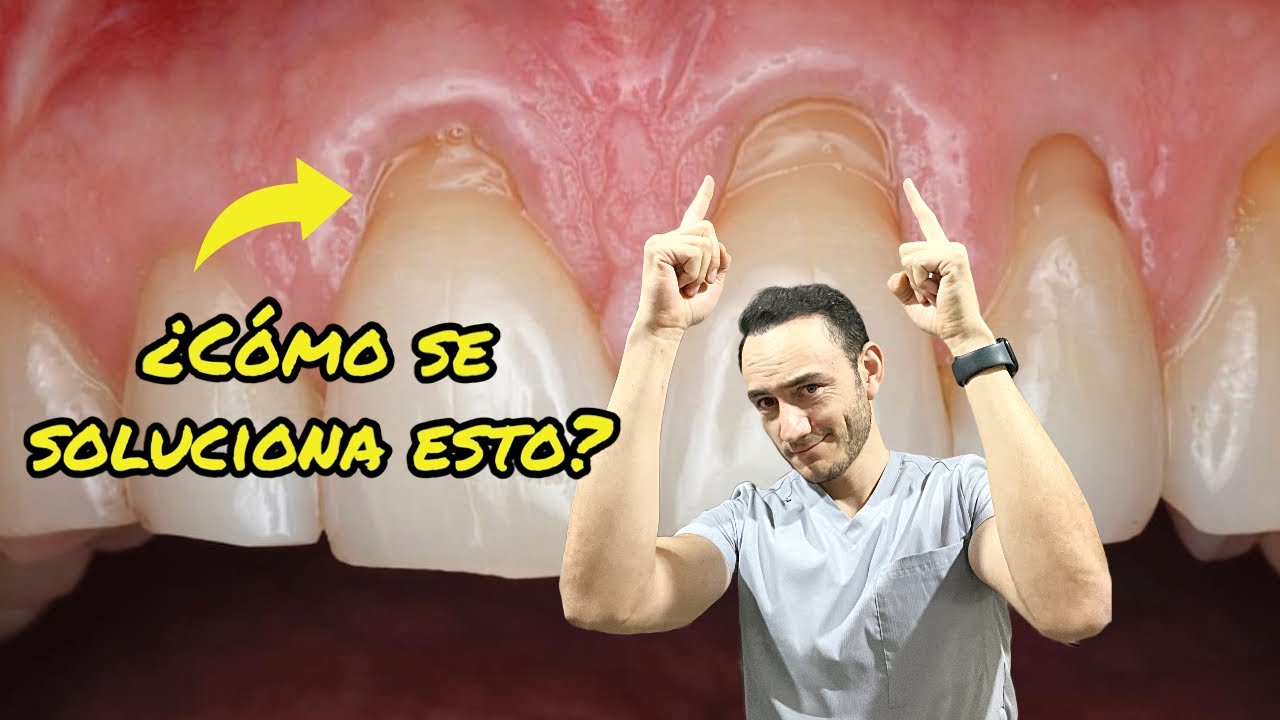 como hacer crecer las encias retraidas