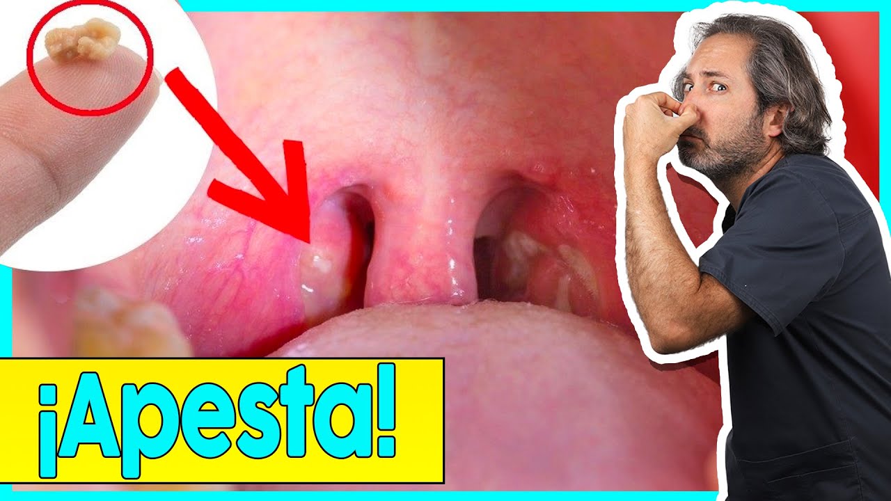 como quitar los granos de la garganta