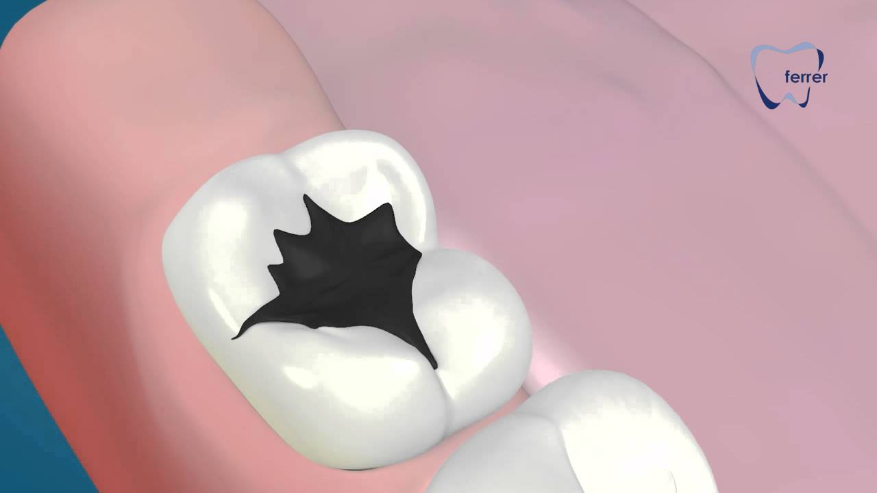 como rellenar el hueco de una muela