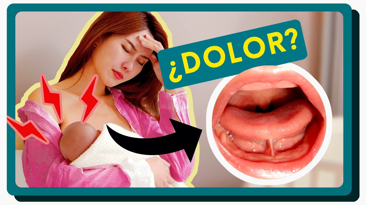 como se ve el frenillo en bebes