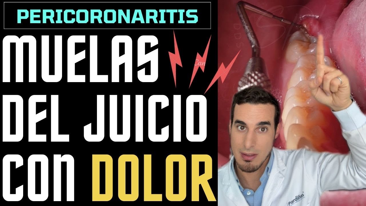 como se ve una muela del juicio infectada