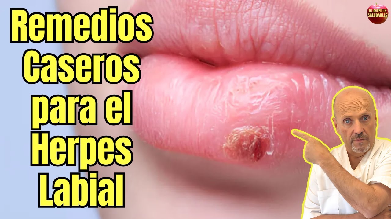 crema para herpes labial sin receta