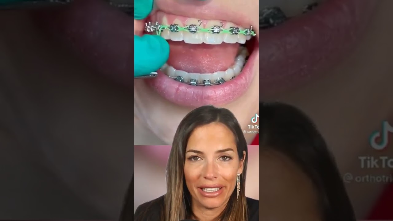 cuanto tiempo se llevan las gomas en los brackets