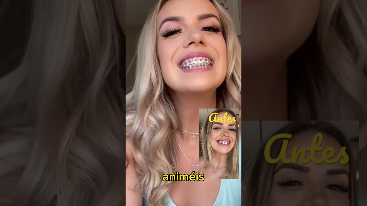 dientes antes y despues de los brackets