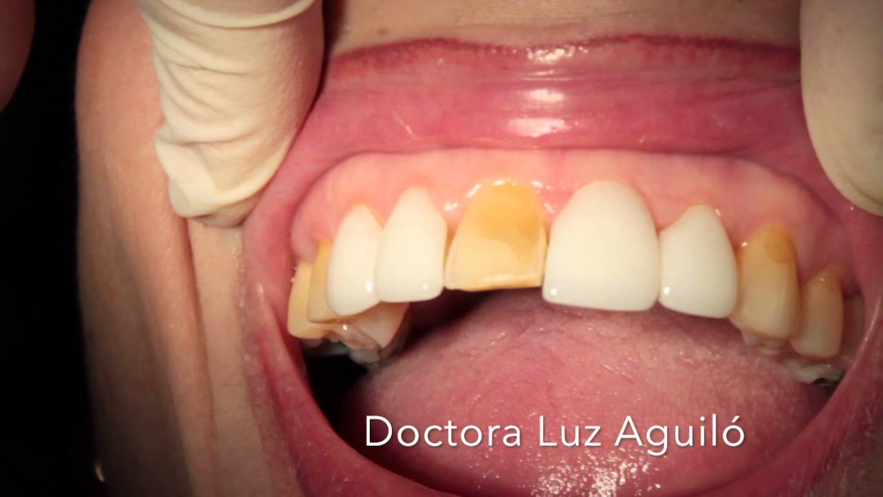 dientes con fundas antes y despues
