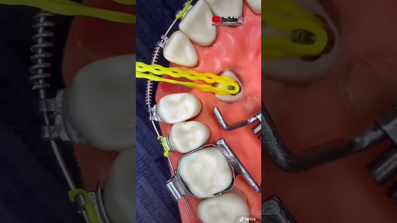 dientes que salen fuera de lugar