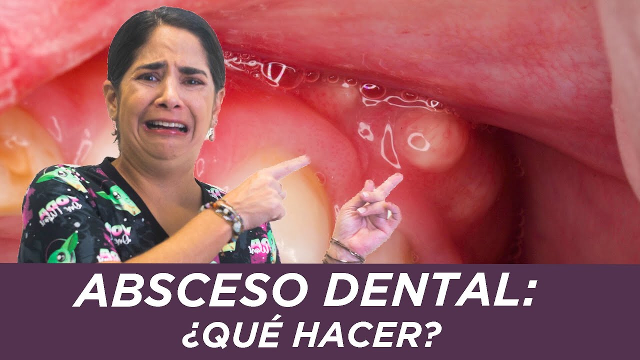 fistula en la encia en niños