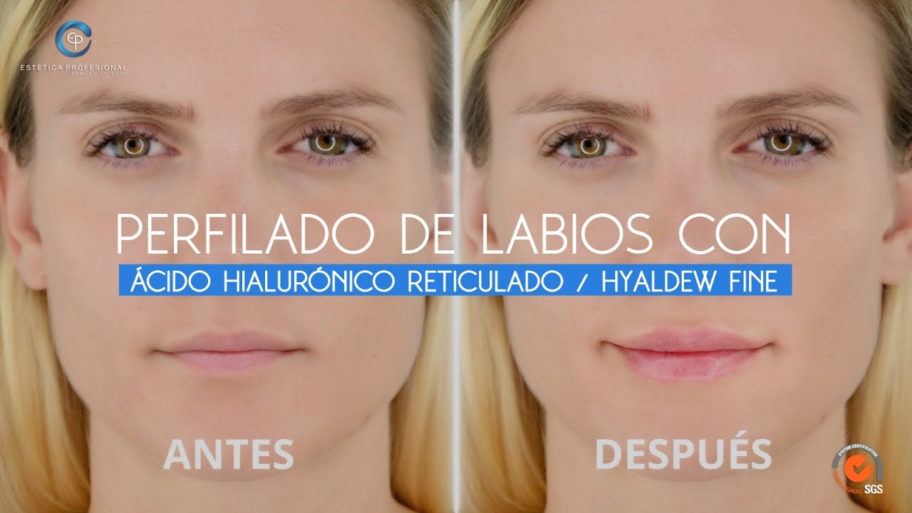 hidratación labios con ácido hialurónico precio
