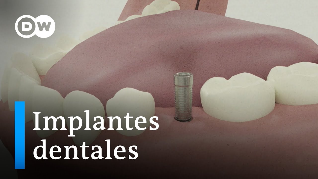 implantes dentales en un día opiniones