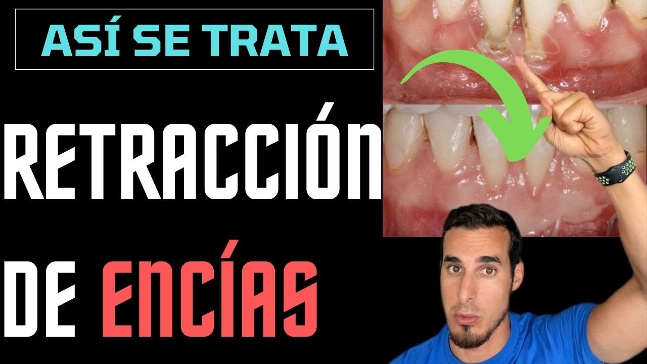 injerto de encías antes y después