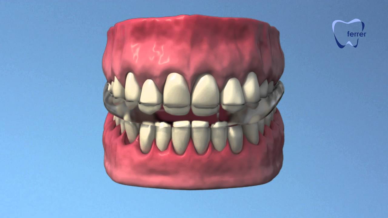 la ferula de descarga mueve los dientes