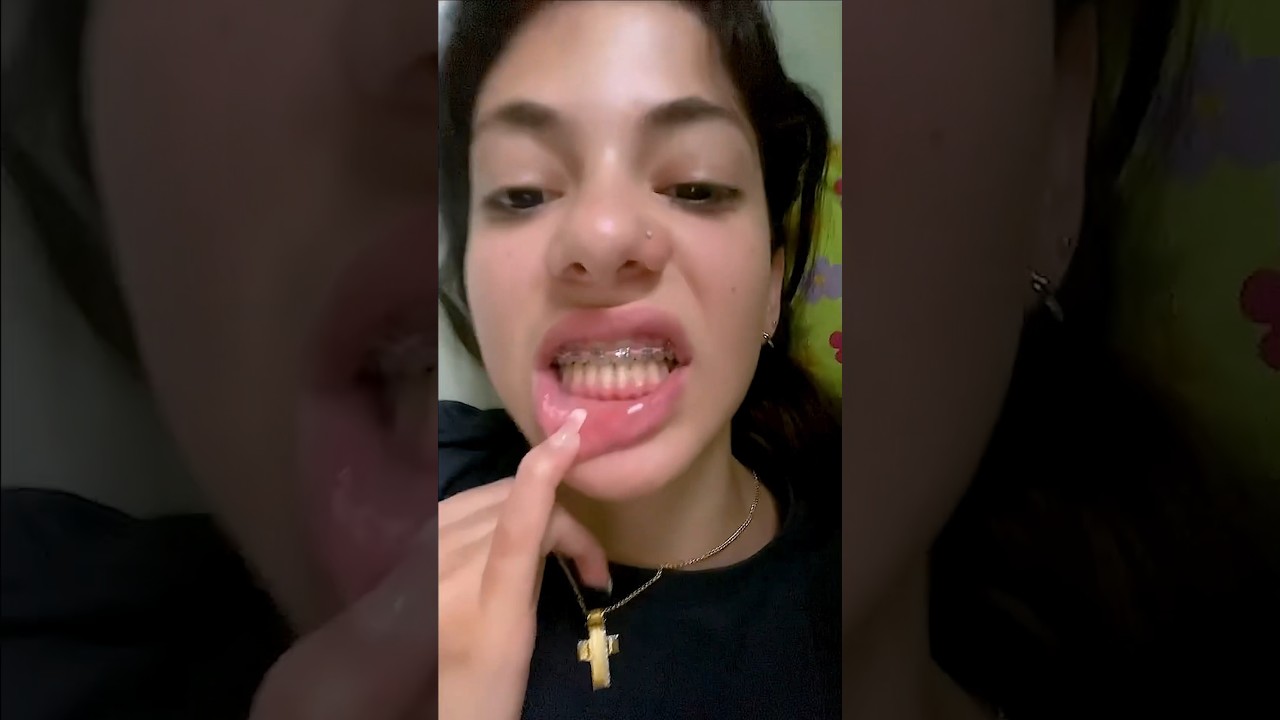 los brackets se ponen arriba y abajo al mismo tiempo