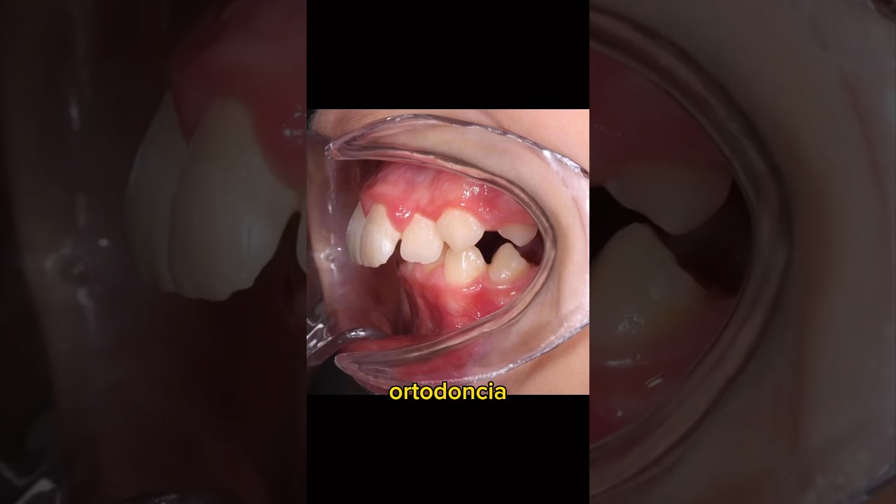 maloclusión clase 2 antes y después