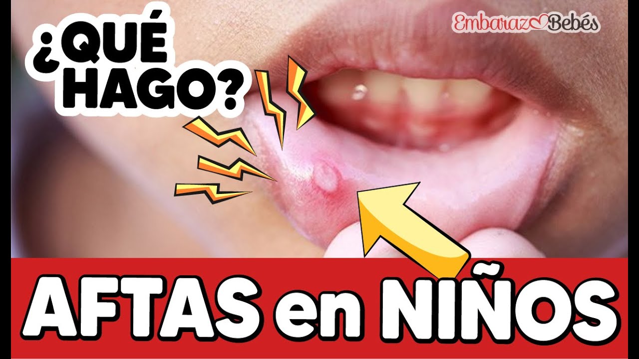 medicamento para las aftas en niños