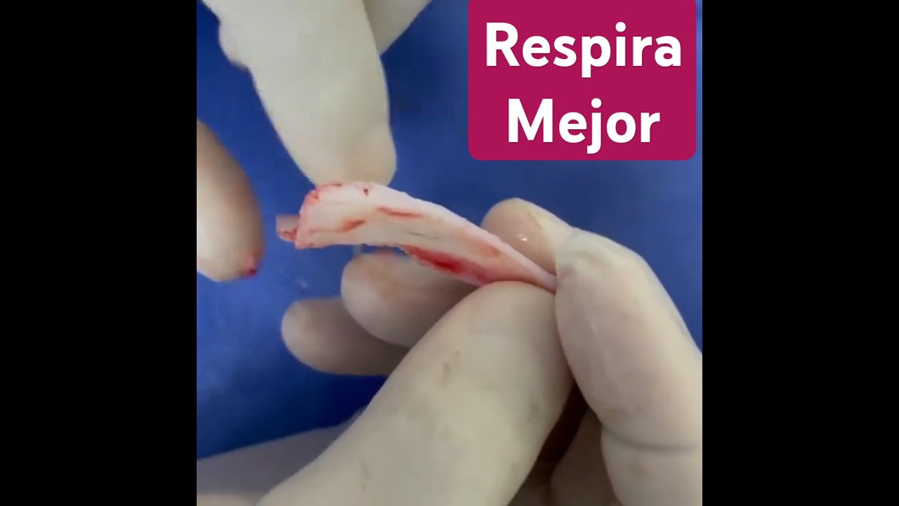 operacion de nariz para respirar bien