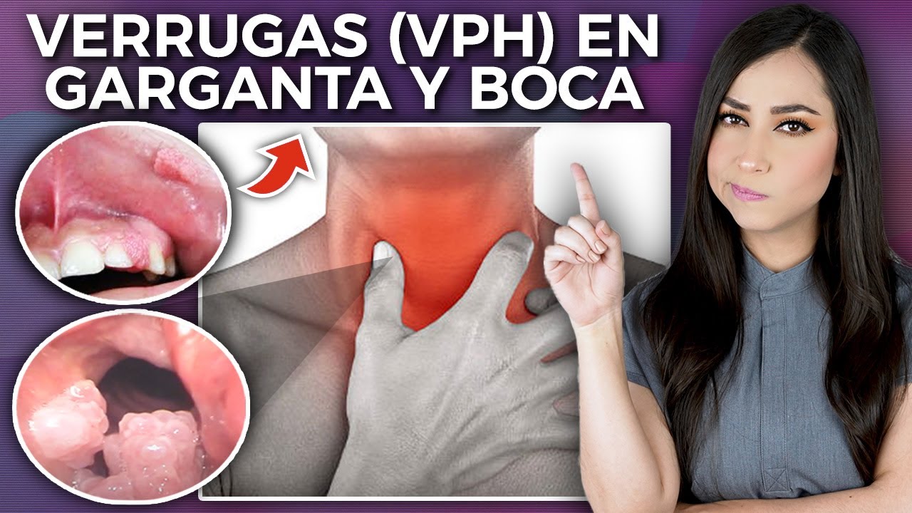papiloma en la boca tiene cura