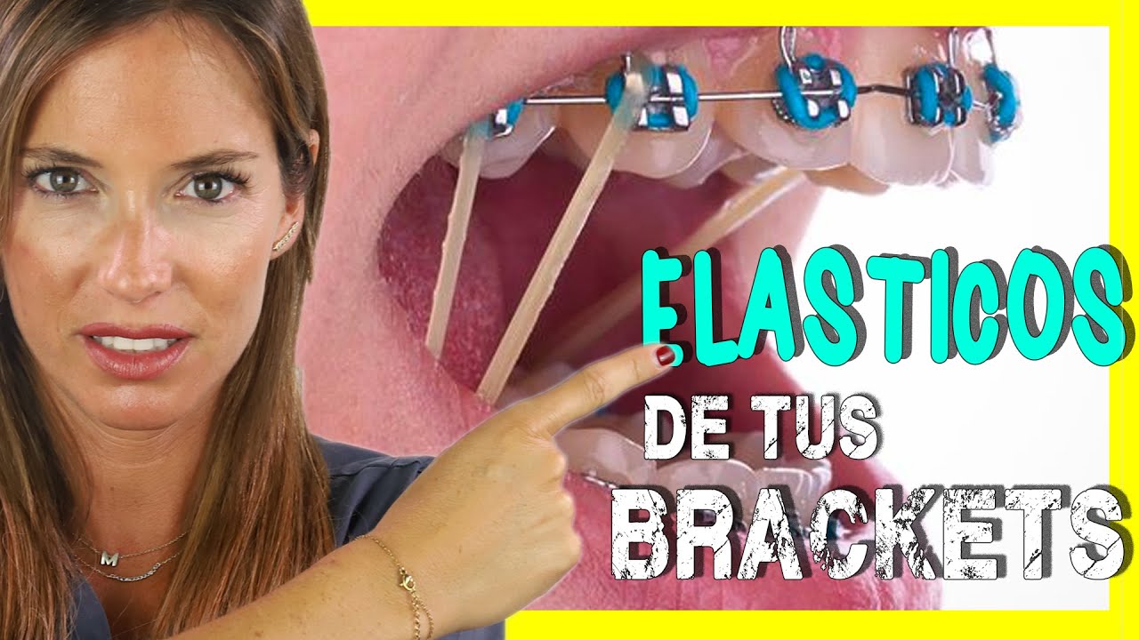 para que sirven las gomas en invisalign