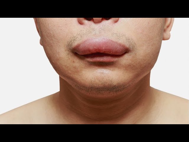 porque amanezco con los labios hinchados