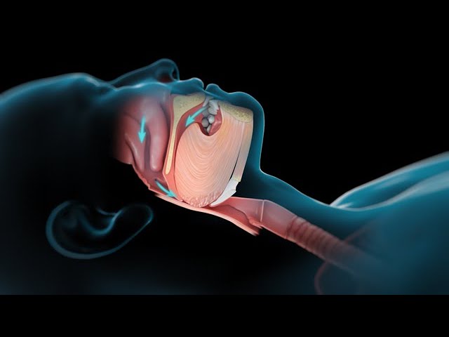 porque me atraganto con mi saliva cuando duermo