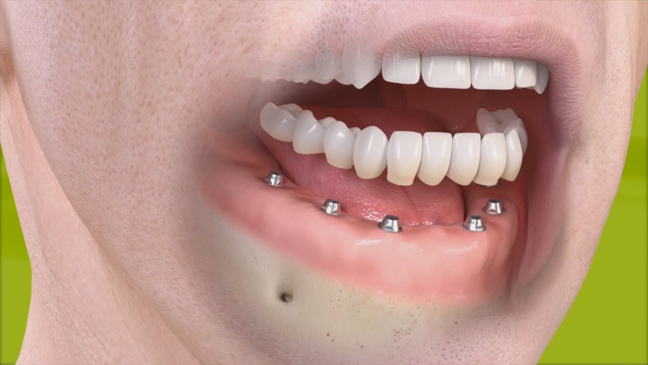 prótesis fija sobre 6 implantes precio