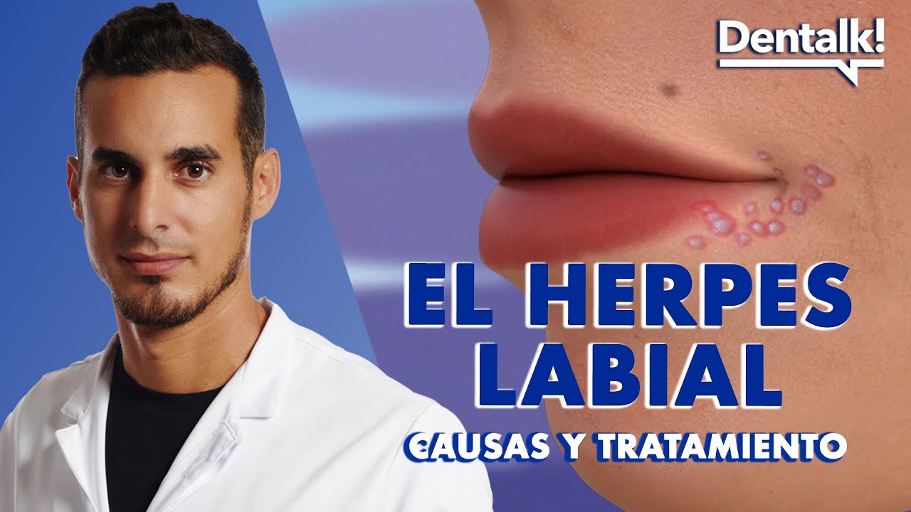 que es una calentura en el labio