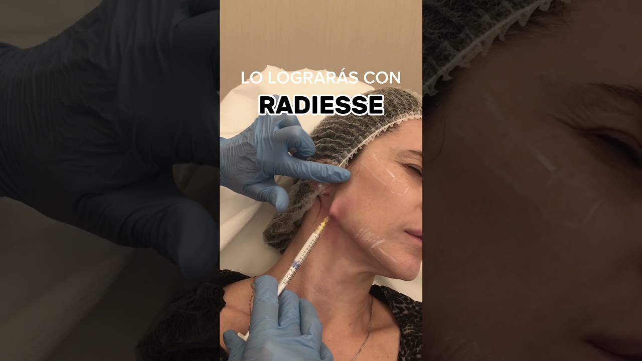 redefinir óvalo facial con ácido hialurónico