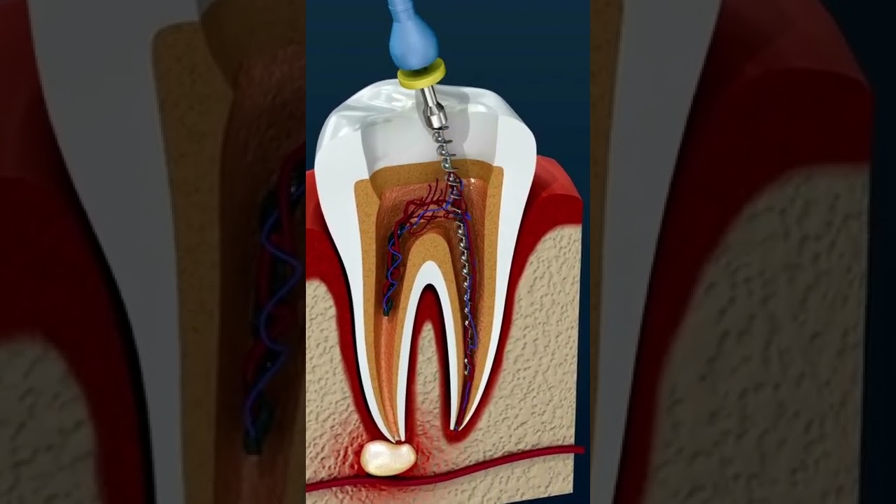 se puede hacer endodoncia con infeccion