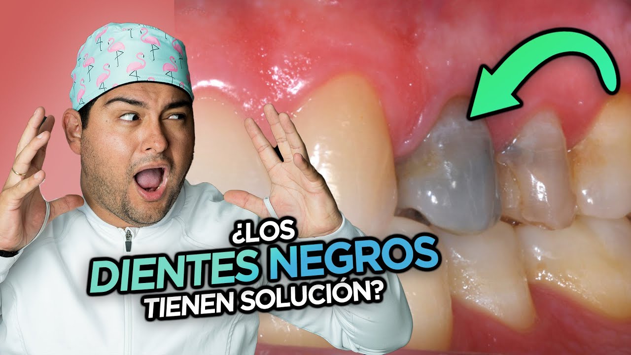 se puede salvar un diente negro