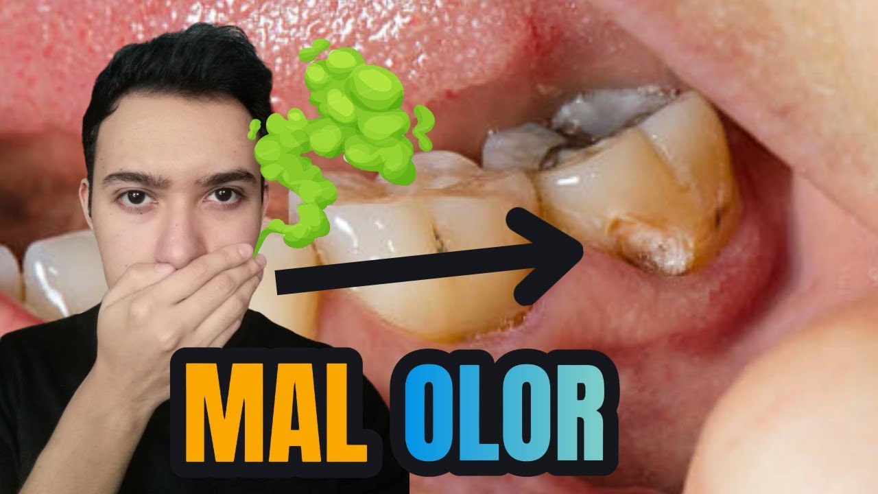si tienes una muela picada te huele la boca