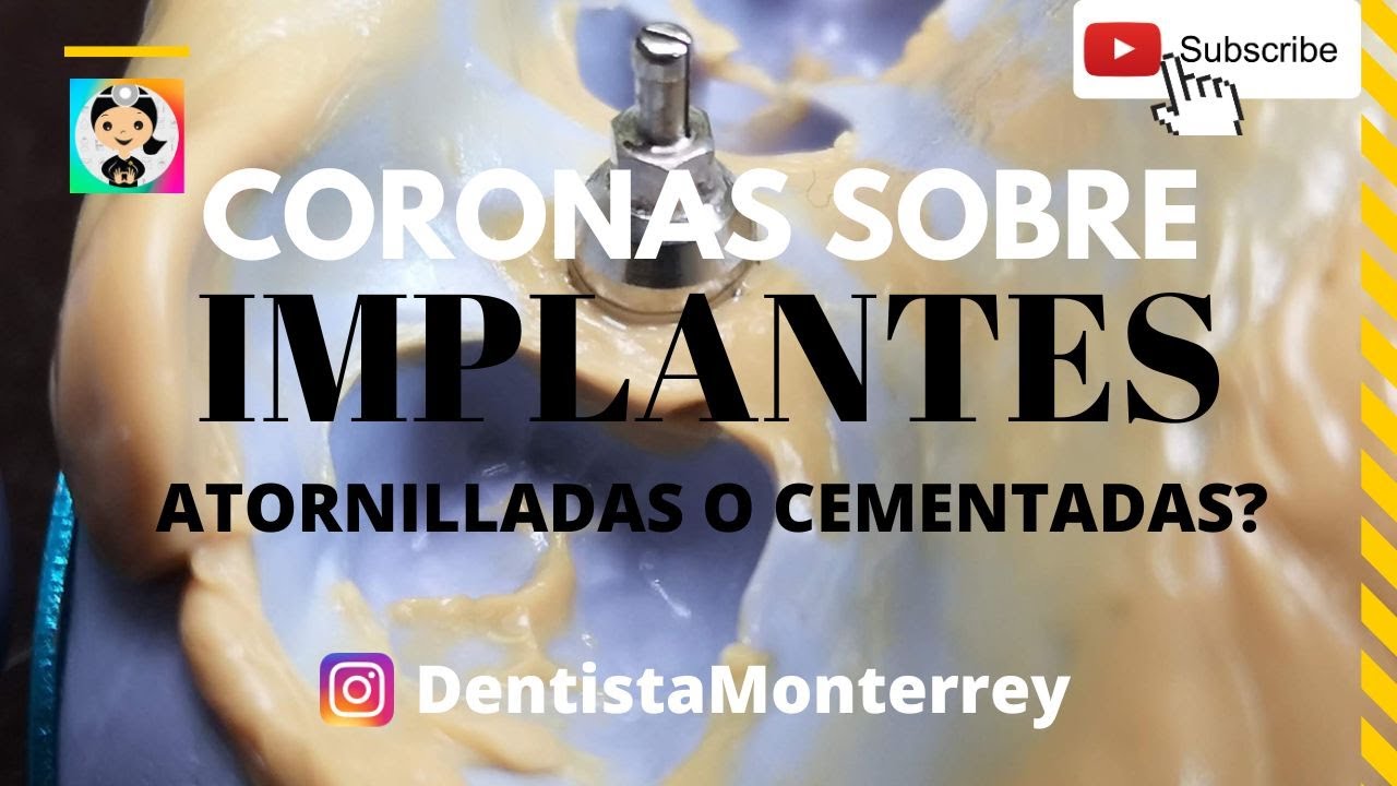 tipos de coronas para implantes dentales