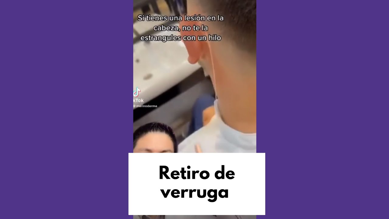 verruga con hilo no se cae