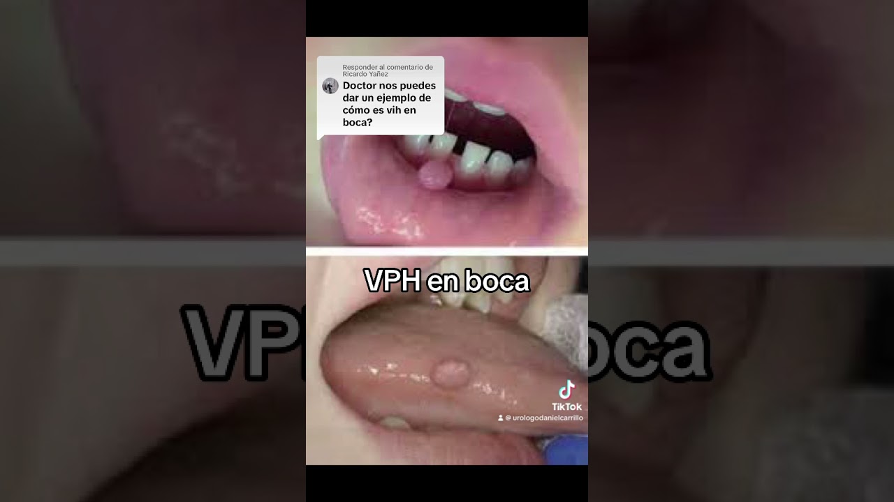 virus del papiloma humano en lengua